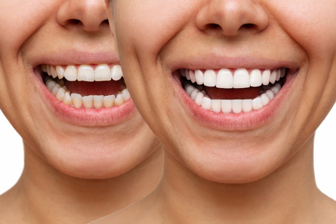 Young woman trying on dental veneers